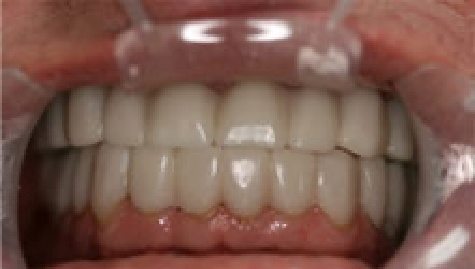 Close up of flawless teeth after Snap On Smile