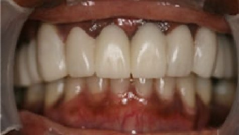 Close up of flawless teeth after Snap On Smile