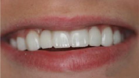 Close up of flawless teeth after Snap On Smile