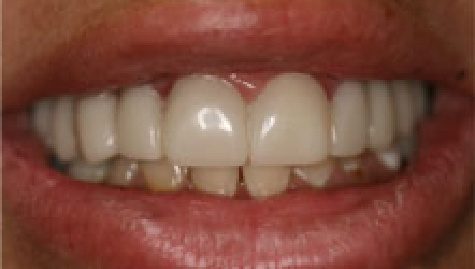 Close up of flawless teeth after Snap On Smile