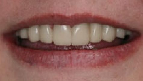 Close up of flawless teeth after Snap On Smile