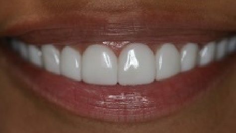 Close up of flawless teeth after Snap On Smile