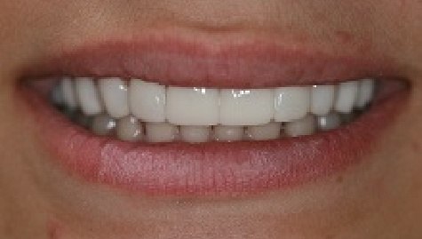 Close up of flawless teeth after Snap On Smile