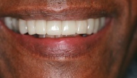 Close up of flawless teeth after Snap On Smile