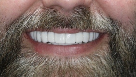 Close up of flawless teeth after Snap On Smile