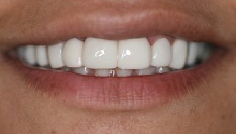 Close up of flawless teeth after Snap On Smile