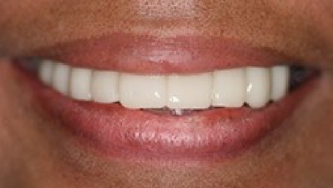 Close up of flawless teeth after Snap On Smile