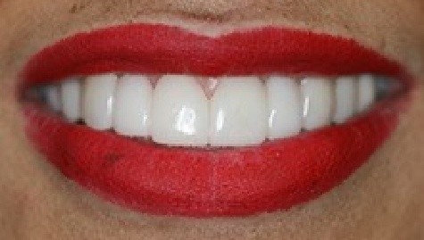 Close up of flawless teeth after Snap On Smile