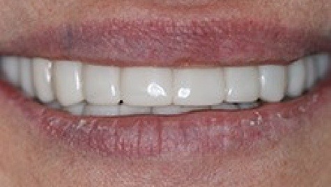 Close up of flawless teeth after Snap On Smile