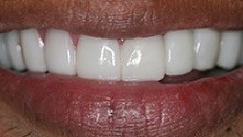 Close up of flawless teeth after Snap On Smile