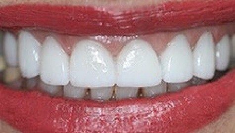 Close up of flawless teeth after Snap On Smile