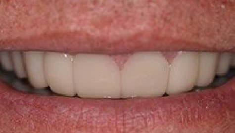 Close up of flawless teeth after Snap On Smile