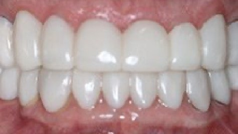 Close up of flawless teeth after Snap On Smile