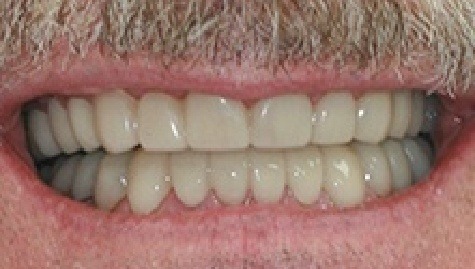 Close up of flawless teeth after Snap On Smile