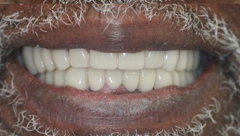 Close up of flawless teeth after Snap On Smile