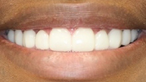 Close up of flawless teeth after Snap On Smile