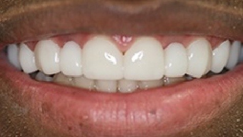 Close up of flawless teeth after Snap On Smile