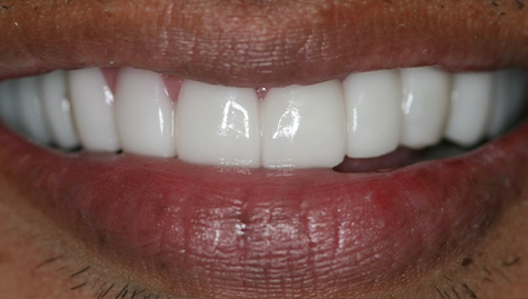 Close up of flawless teeth after Snap On Smile