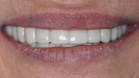 Close up of flawless teeth after Snap On Smile