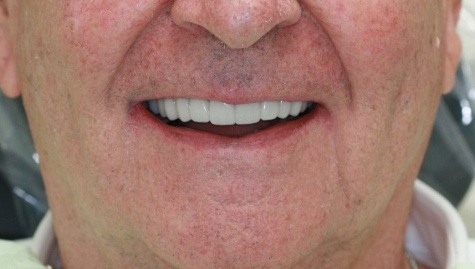 Close up of flawless teeth after Snap On Smile