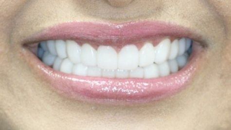 Close up of flawless teeth after Snap On Smile