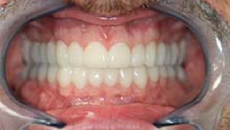 Close up of flawless teeth after Snap On Smile