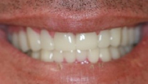 Close up of flawless teeth after Snap On Smile