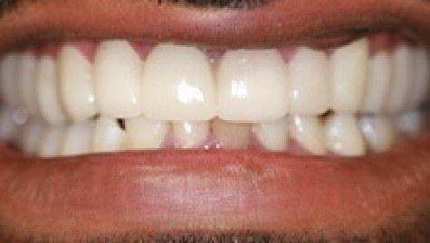 Close up of flawless teeth after Snap On Smile