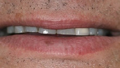 Close up of imperfect smile before Snap On Smile