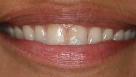 Close up of imperfect smile before Snap On Smile