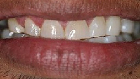 Close up of imperfect smile before Snap On Smile