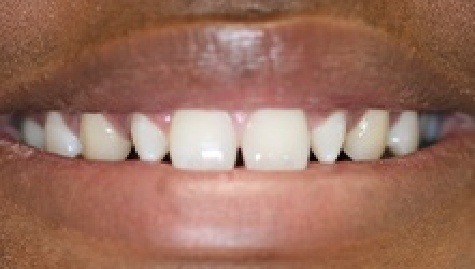 Close up of imperfect smile before Snap On Smile