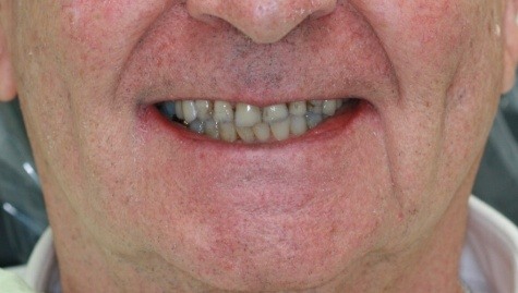 Close up of imperfect smile before Snap On Smile