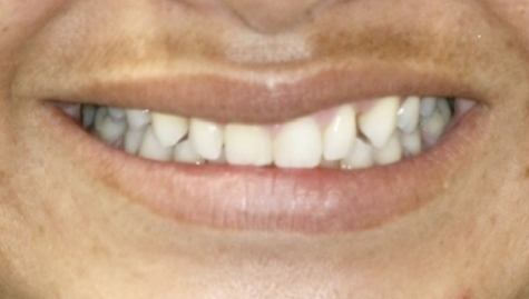 Close up of imperfect smile before Snap On Smile