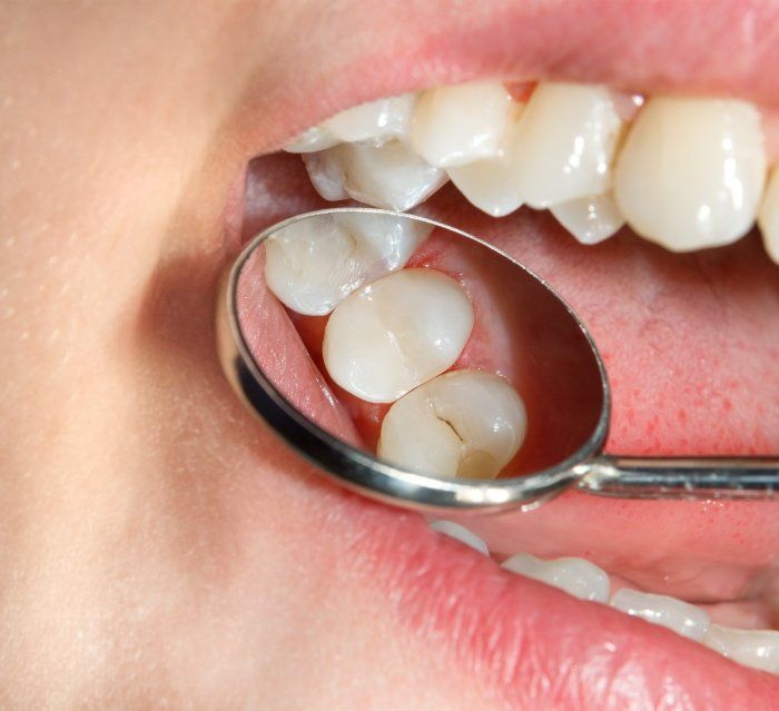 Close up of dental mirror in mouth reflecting tooth colored filling