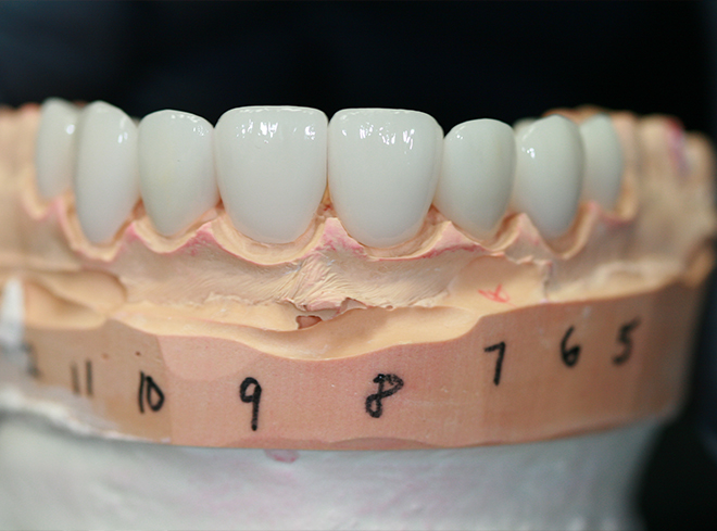 Model of the mouth with several veneers placed over the front teeth