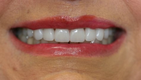 Close up of flawless smile after veneers and Lumineers