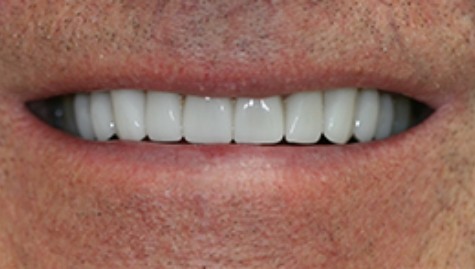 Close up of flawless smile after veneers and Lumineers