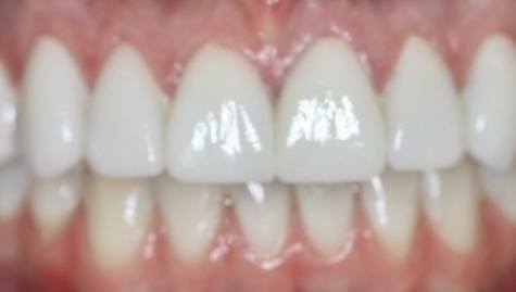 Close up of flawless smile after veneers and Lumineers