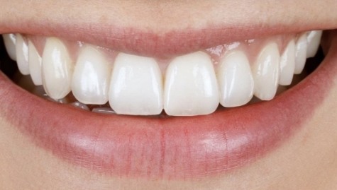 Close up of flawless smile after veneers and Lumineers