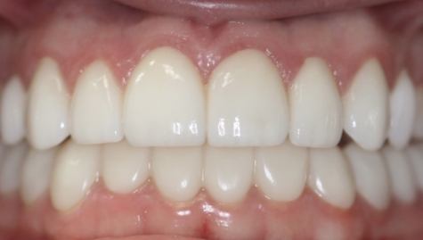 Close up of flawless smile after veneers and Lumineers