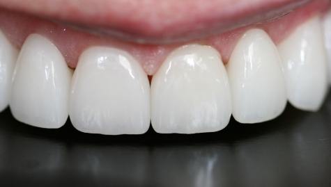 Close up of flawless smile after veneers and Lumineers