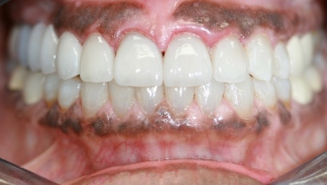 Close up of flawless smile after veneers and Lumineers