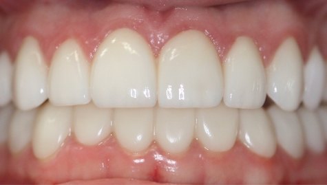 Close up of flawless smile after veneers and Lumineers