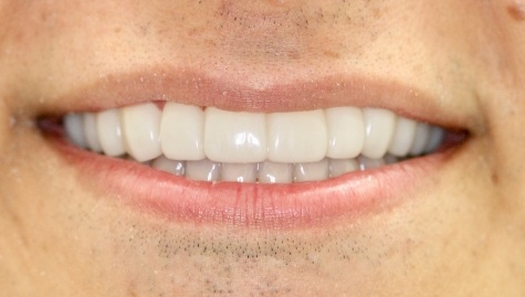 Close up of flawless smile after veneers and Lumineers