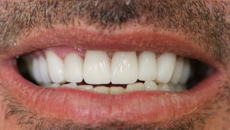 Close up of flawless smile after veneers and Lumineers