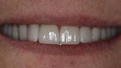 Close up of flawless smile after veneers and Lumineers