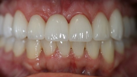 Close up of flawless smile after veneers and Lumineers