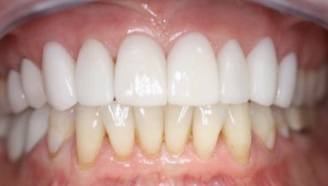 Close up of flawless smile after veneers and Lumineers