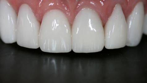 Close up of flawless smile after veneers and Lumineers